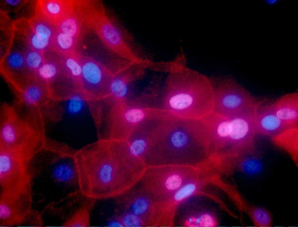 This undated fluorescence-colored microscope image made available by the Natio<em></em>nal Institutes of Health in September 2016 shows a culture of human breast cancer cells.