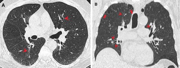 Marijuana, cigarette smokers at increased risk of emphysema