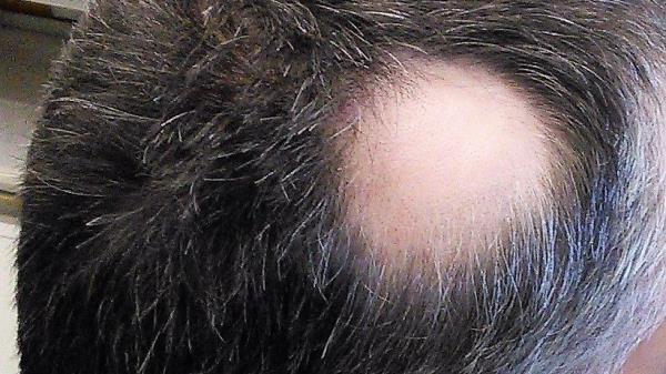 Hair loss, what is Litfulo (ritlecitinib), the pill for the treatment of severe alopecia areata