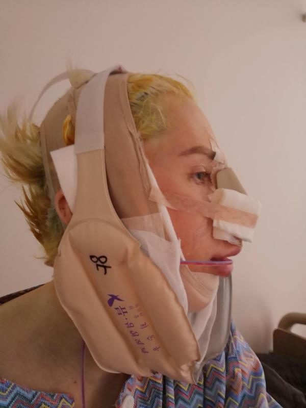 Oli Lo<em></em>ndon in bandages while recovering from facial surgery